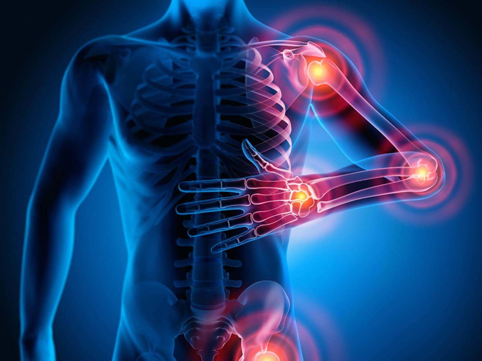 Arthritis